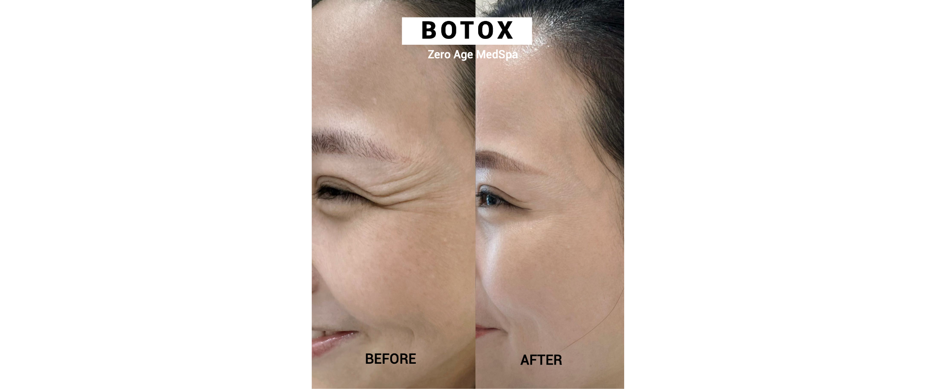 Botox before and after results at Zero Age MedSpa in Katy, TXslider_item_7FNr8E