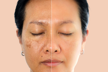 Brightening and pigment correction treatment at Zero Age MedSpa in Katy & Houston, TX