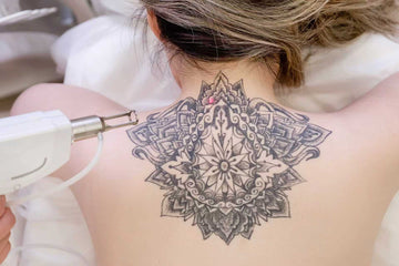 Laser tattoo removal treatment at Zero Age MedSpa in Katy & Houston, TX