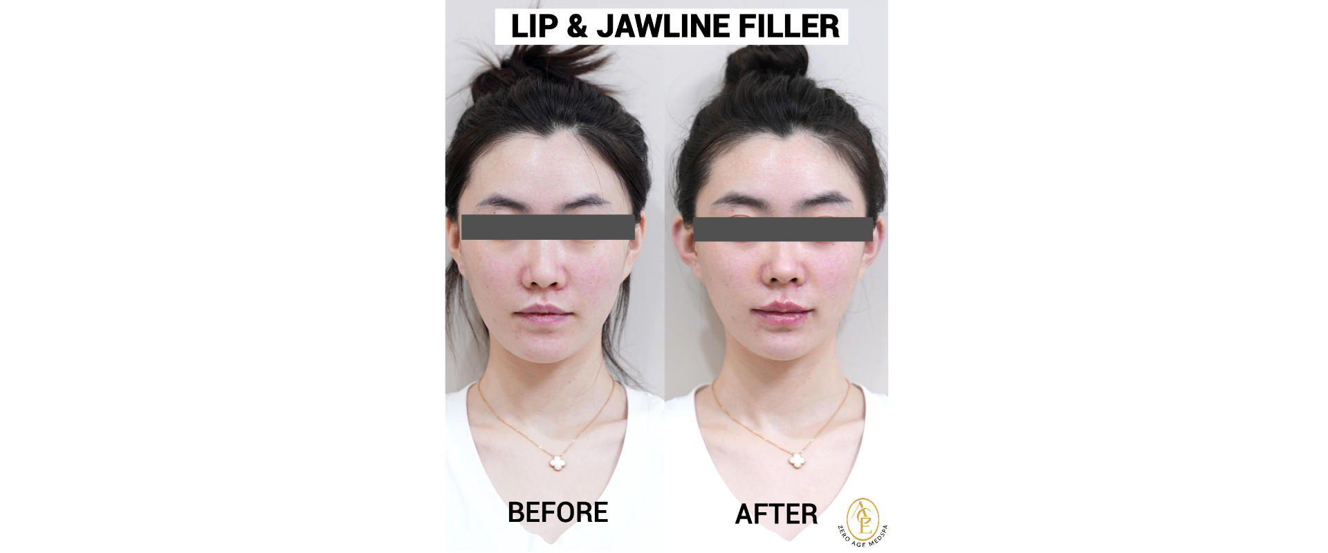 Lip and jawline filler before and after results at Zero Age MedSpa in Katy, TXslider_item_UDCNde