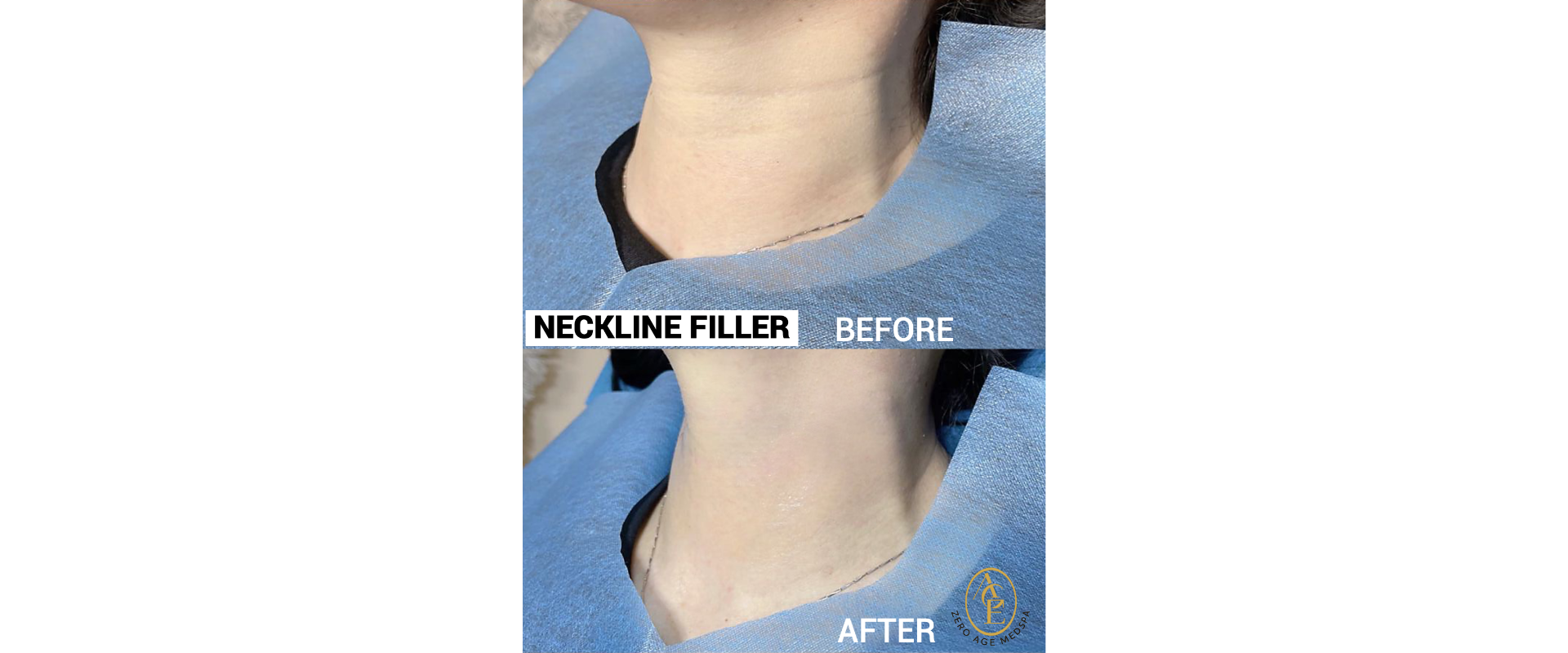 Neckline filler before and after results at Zero Age MedSpa in Katy, TXslider_item_ypYTVE