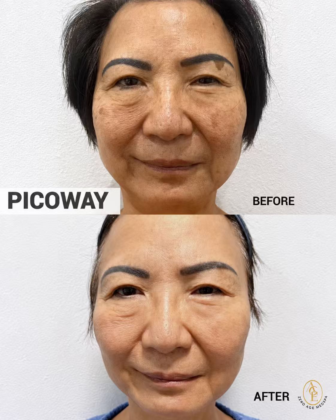 PicoWay laser before and after results at Zero Age MedSpa in Katy, TXslider_item_jEfV7e