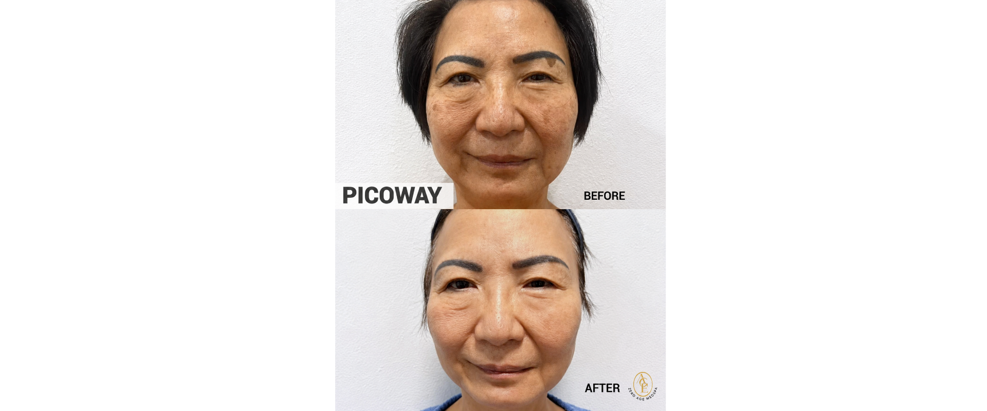 PicoWay laser before and after results at Zero Age MedSpa in Katy, TXslider_item_bzgz4c