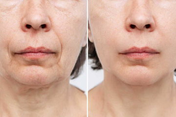 Skin firming and lifting treatment at Zero Age MedSpa in Katy & Houston, TX