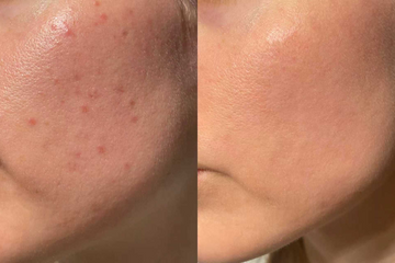 Skin texture and pore refinement treatment at Zero Age MedSpa in Katy & Houston, TX
