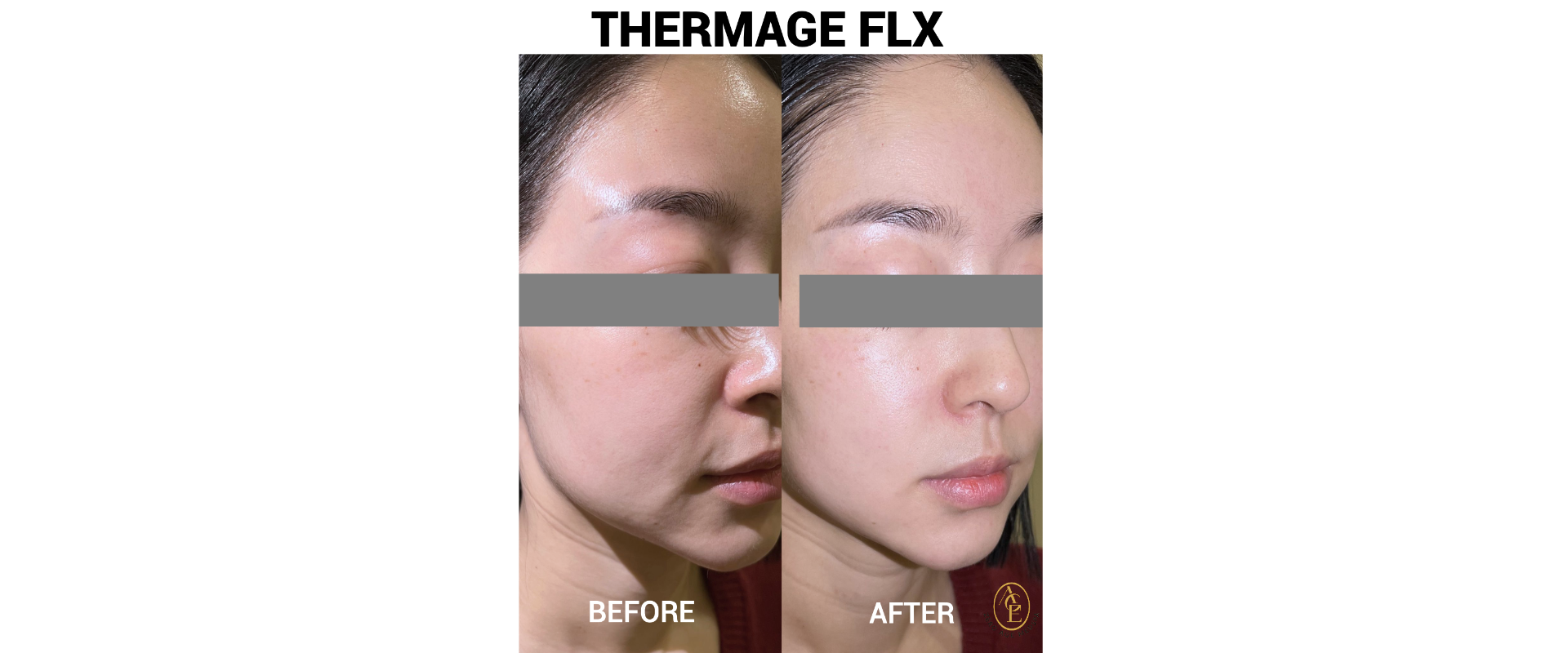 Thermage FLX skin tightening before and after results at Zero Age MedSpa in Katy, TXslider_item_wCKFY9