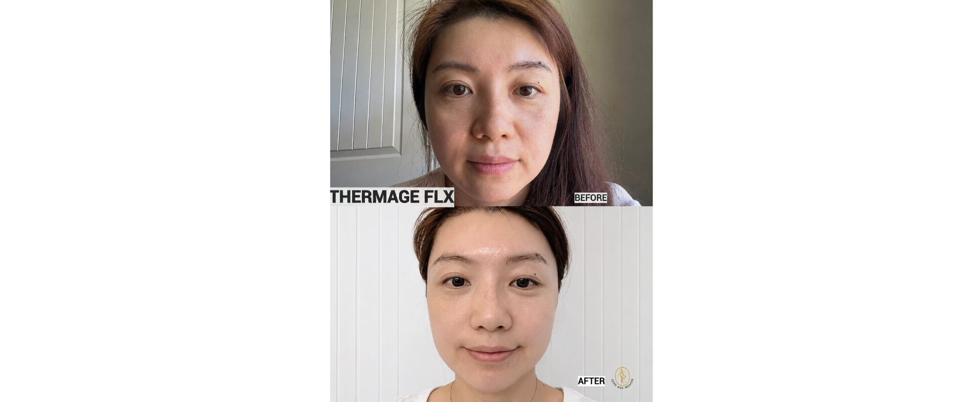 Thermage FLX before and after results at Zero Age MedSpa in Katy, TXslider_item_4ULyrx